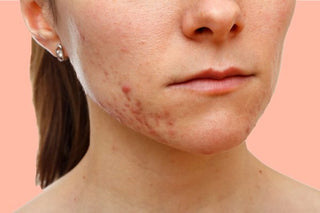 Control your acne-prone skin with these makeup tips!